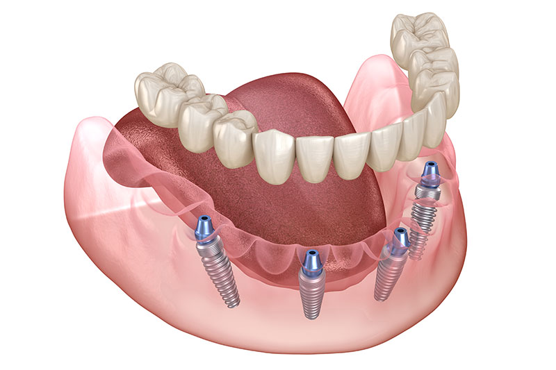 All on 4 Dental Implants in Eastern Washington