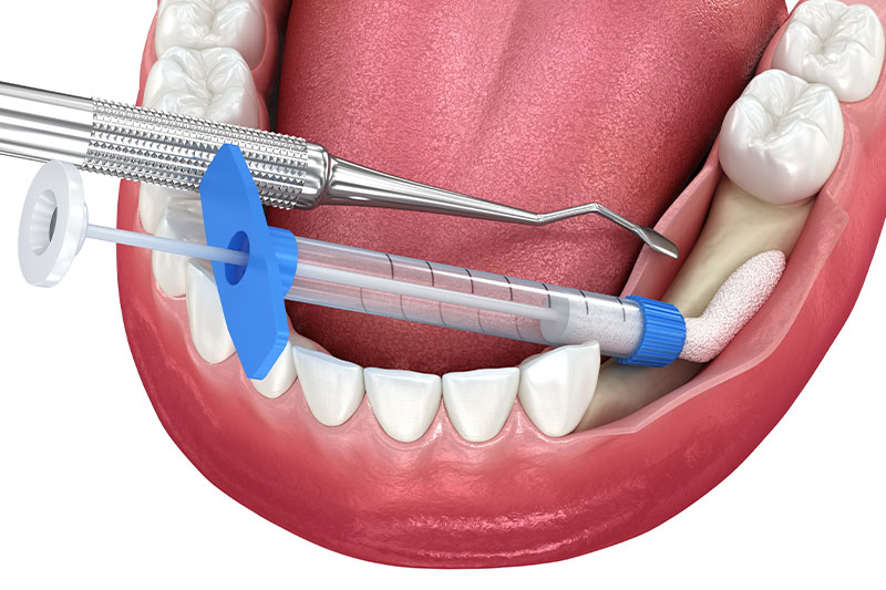 Bone Augmentation in Eastern Washington
