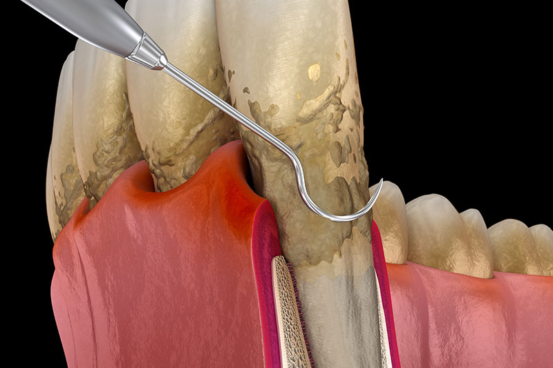 Periodontal Therapy in Eastern Washington