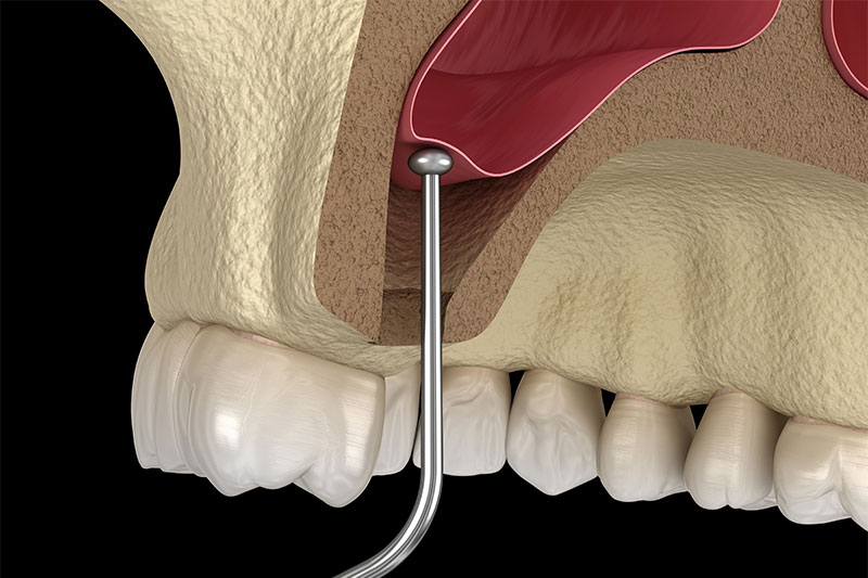 Sinus Augmentation in Eastern Washington