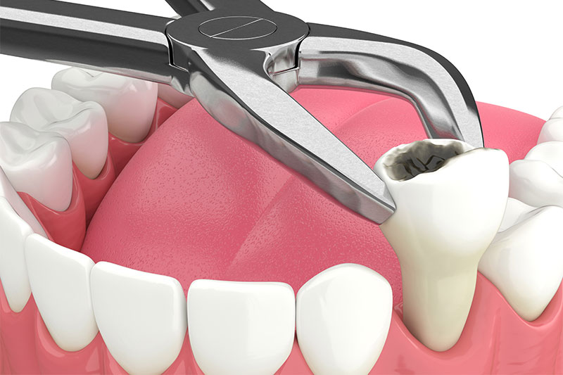 Tooth Extractions in Eastern Washington