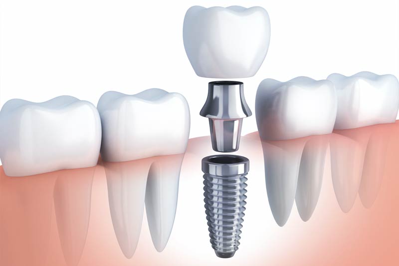 Implants Dentist in Eastern Washington