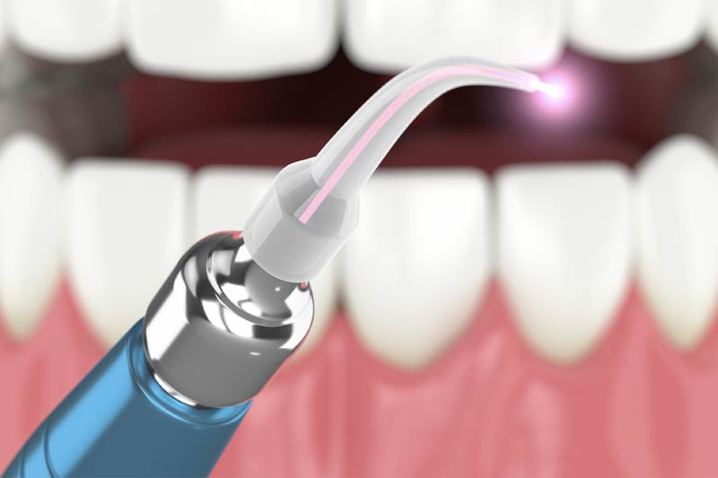 Laser Gum Treatment (LANAP) in Eastern Washington